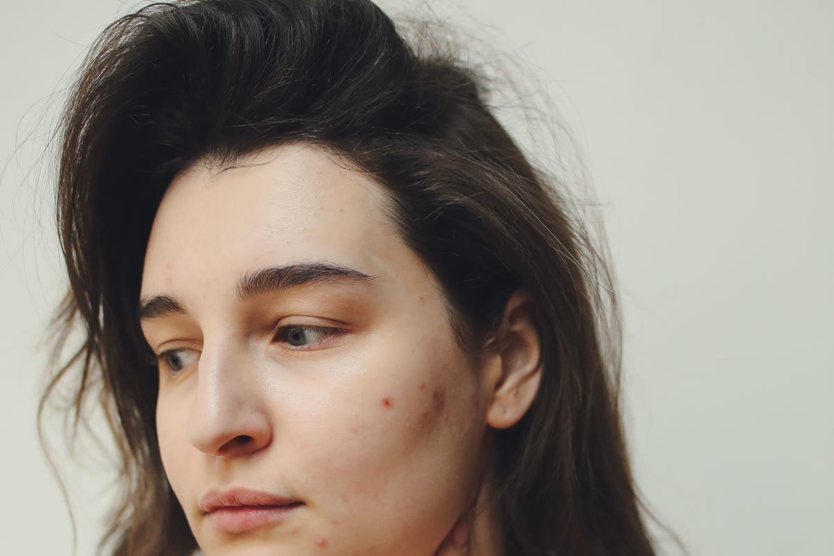 A young woman with visible adult breakouts looking pensively to the side
